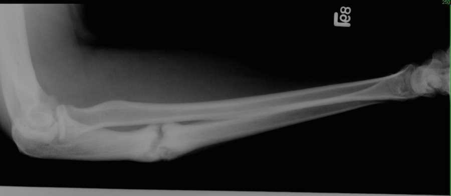 Nonunion of Ulna Fracture on X-ray - CTisus CT Scan