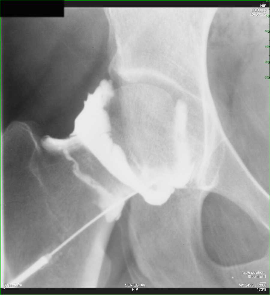 Normal Hip Arthrogram - CTisus CT Scan