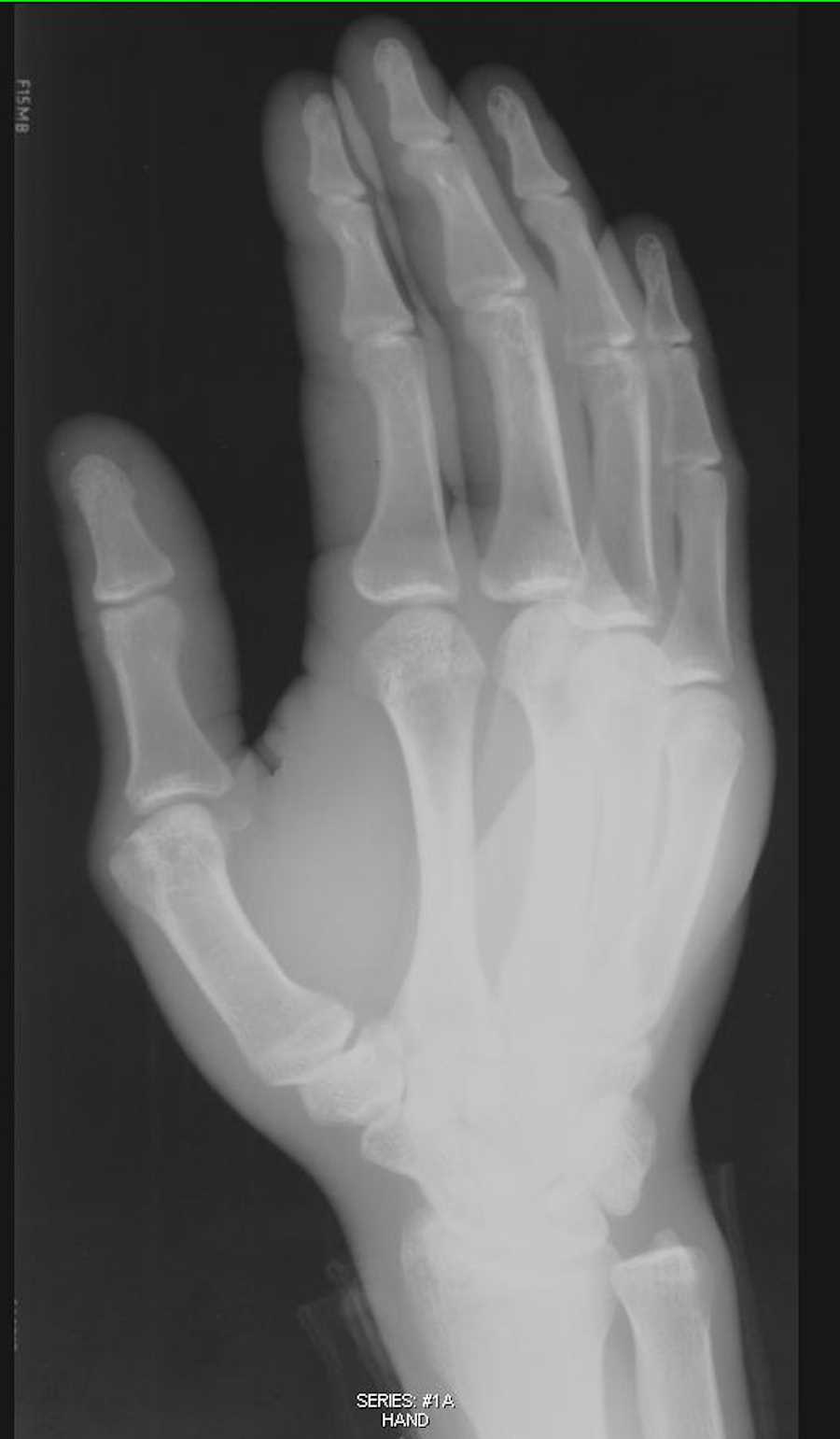 x-ray-hand-with-soft-tissue-swelling-x-rays-case-studies-ctisus-ct