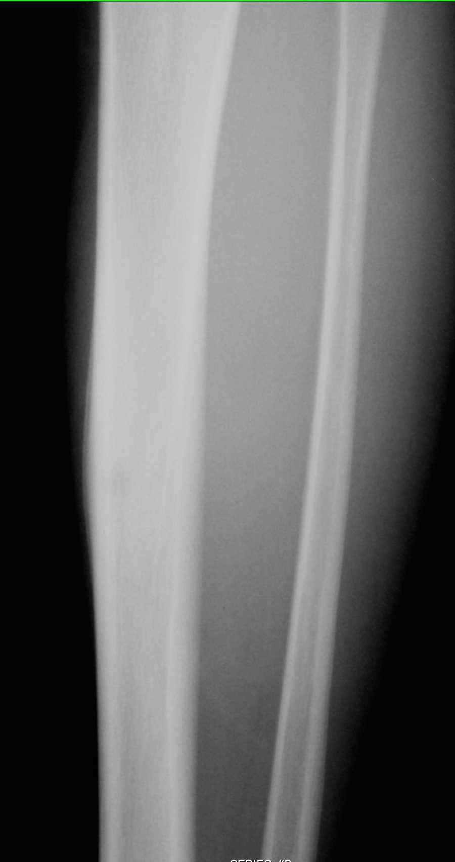 Osteoid Osteoma Tibia on X-ray - CTisus CT Scan