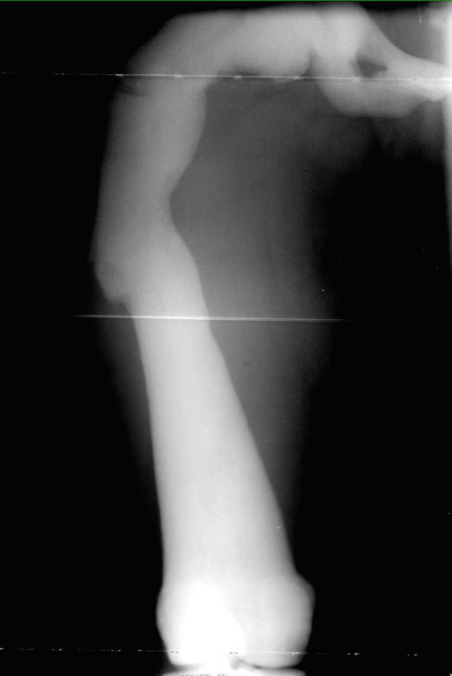 Osteopetrosis on X-ray - CTisus CT Scan