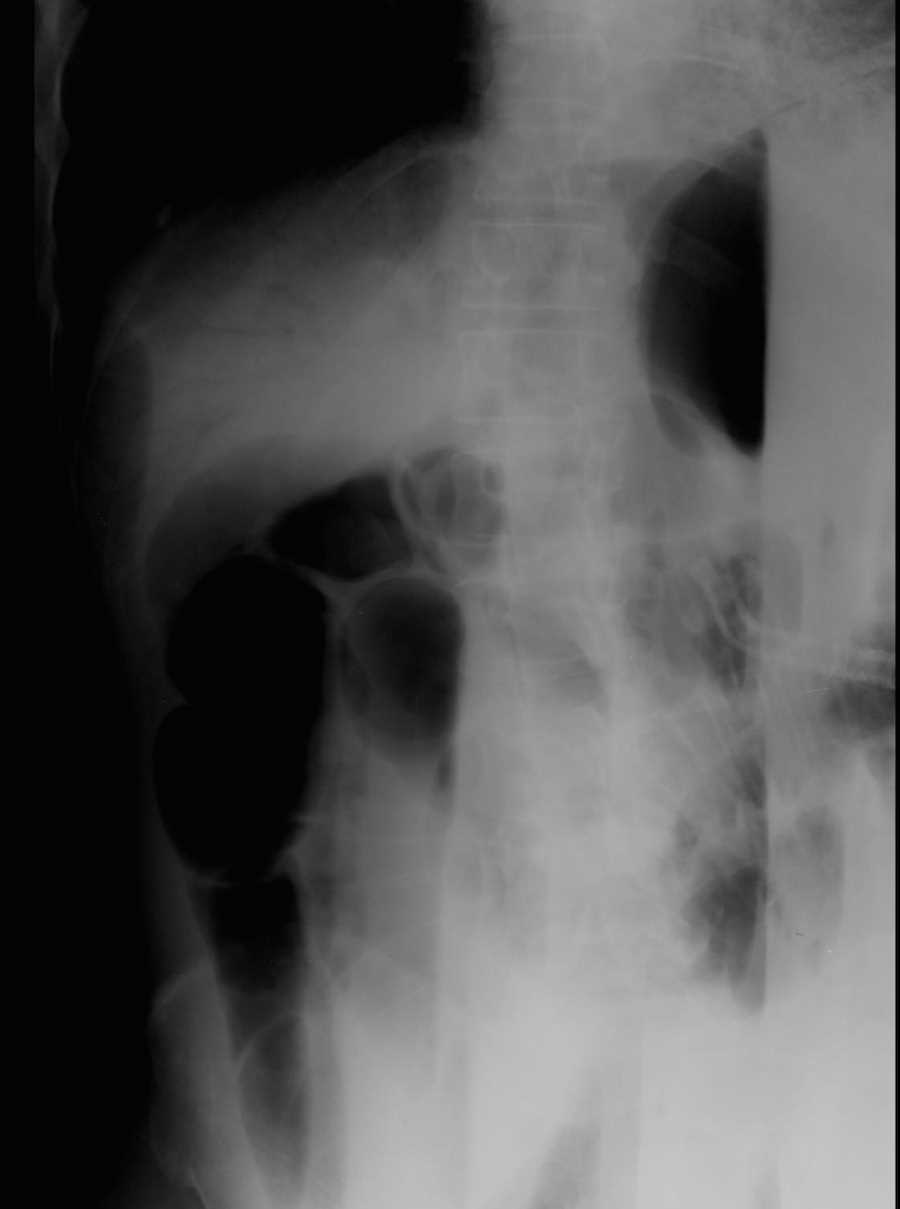 Portal Venous Air on X-ray - CTisus CT Scan