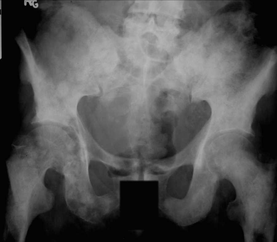 Prostate Metastases to bone on X-ray - CTisus CT Scan