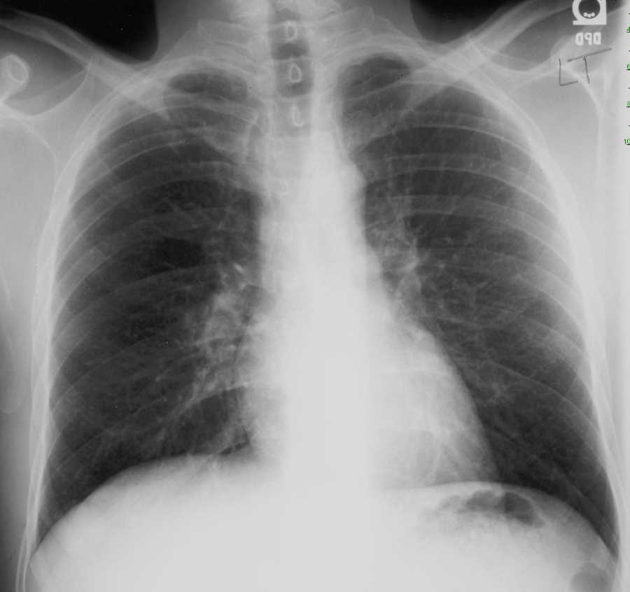 Pulmonary Arteriovenous Malformation (AVM) on Chest X-ray - CTisus CT Scan