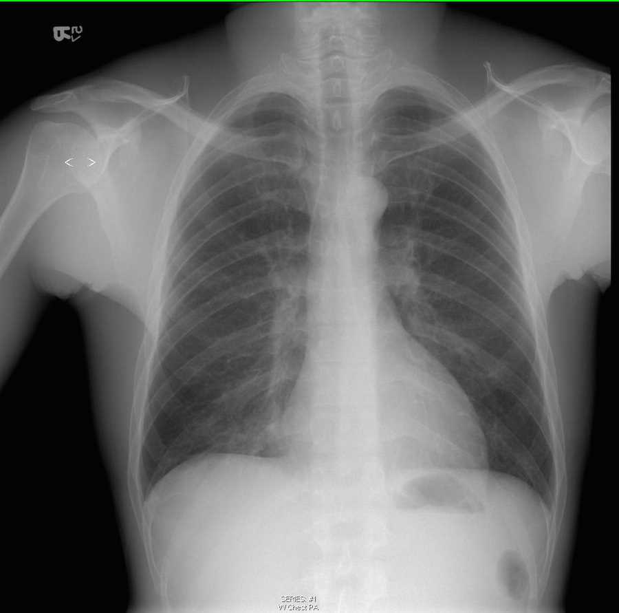Right Middle Lobe Pneumonia - CTisus CT Scan