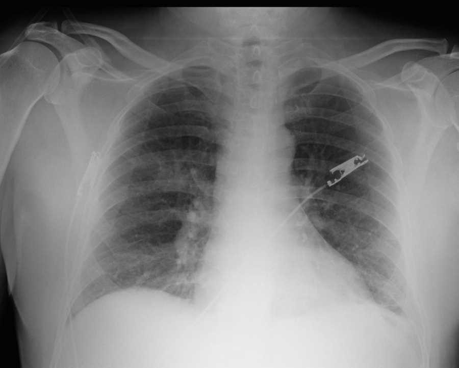 Right Upper Lobe Lung Mass - CTisus CT Scan