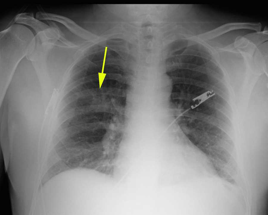 Right Upper Lobe Lung Mass X Rays Case Studies CTisus CT Scanning