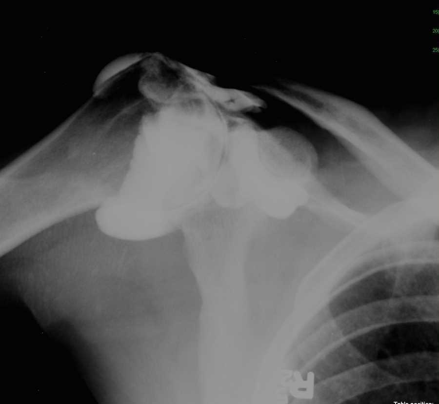 Rotator Cuff Tear on Shoulder Arthrogram - CTisus CT Scan