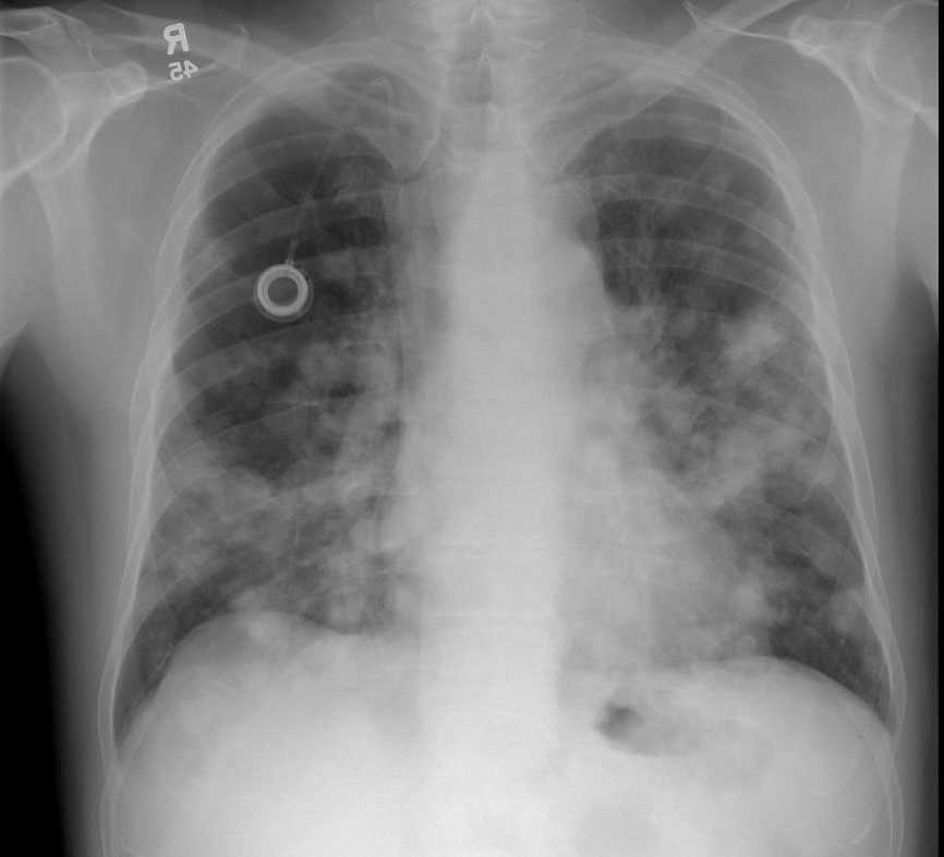 Lung Metastases on Chest X-ray - CTisus CT Scan