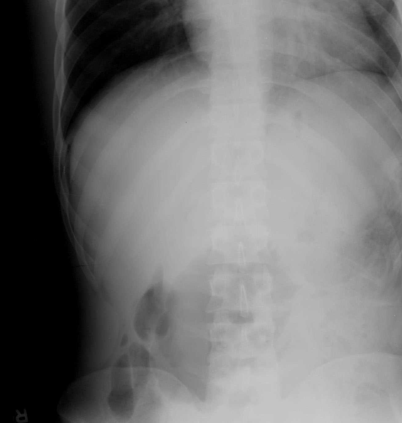 duodenal ulcer x ray