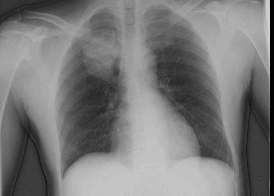 Right Upper Lobe Lung Cancer On X ray And CT X Rays Case Studies 