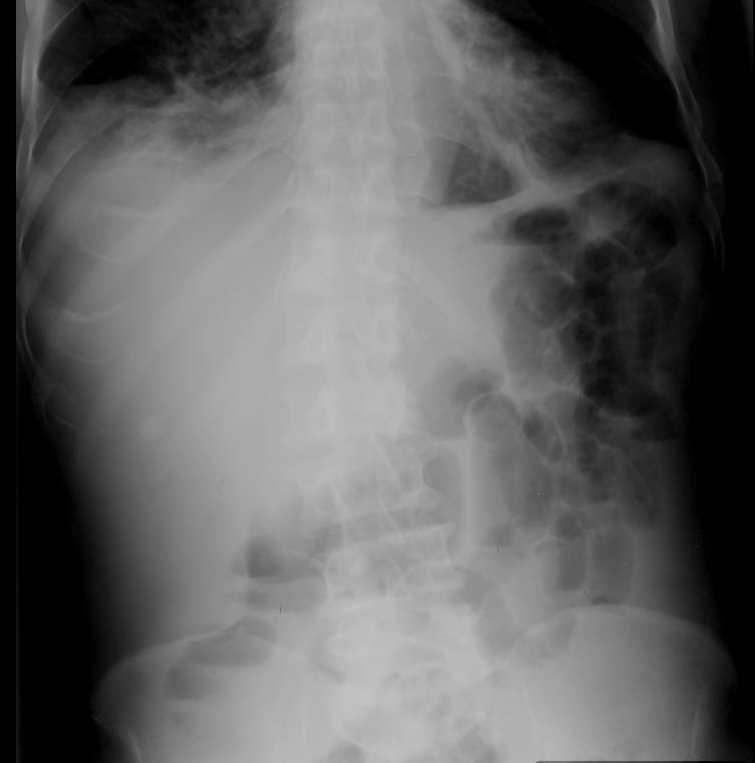 Accessory Nipple on Abdominal X-ray - CTisus CT Scan