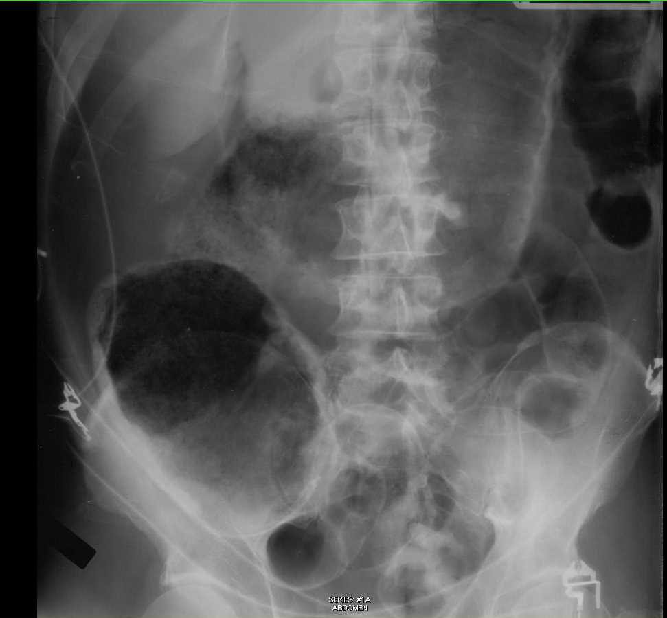 Large Pneumoperitoneum on Abdominal X-ray - CTisus CT Scan