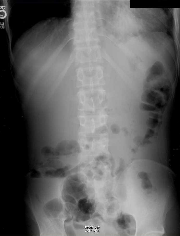 Left Lower Lobe Pneumonia in Abdominal X-ray - CTisus CT Scan