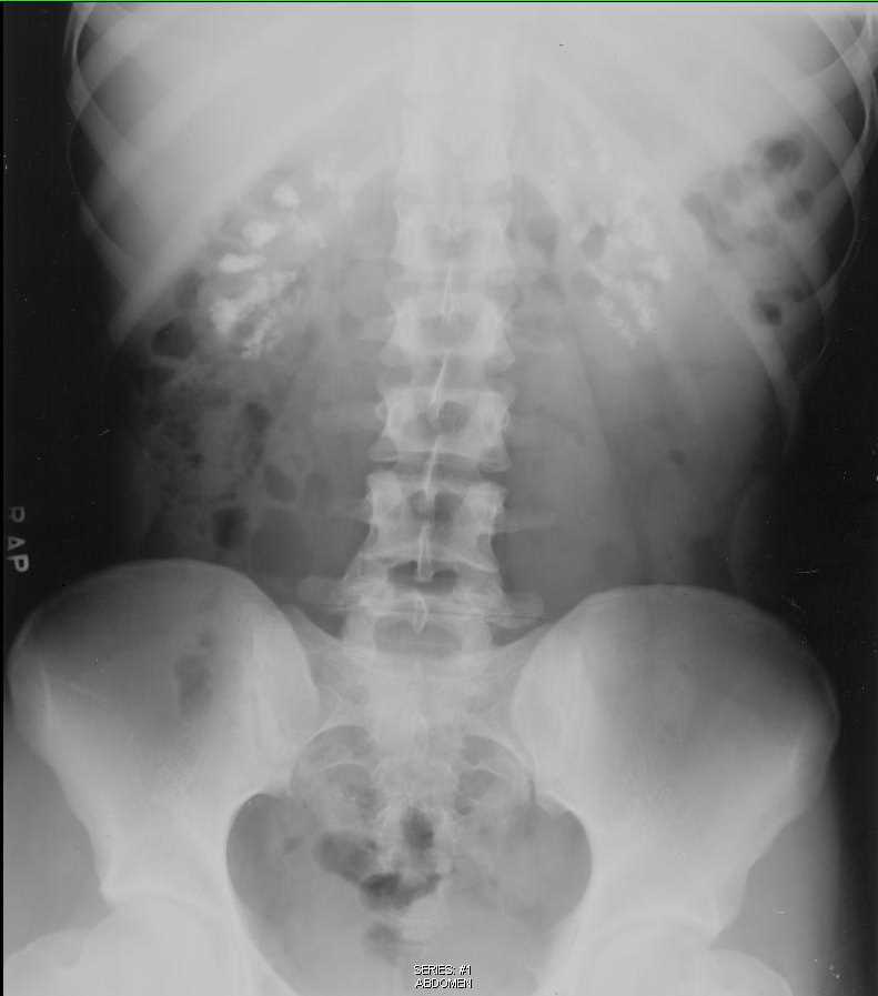 chronic pancreatitis x ray