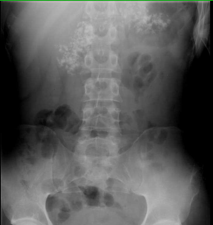 Chronic Pancreatitis on Abdominal X-ray - CTisus CT Scan