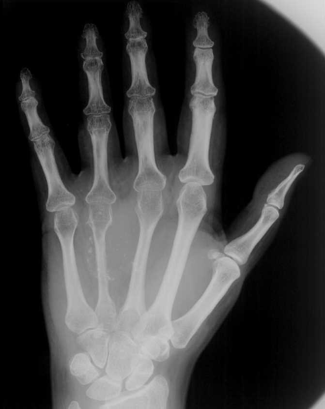 Soft Tissue Hemangioma Hand - CTisus CT Scan