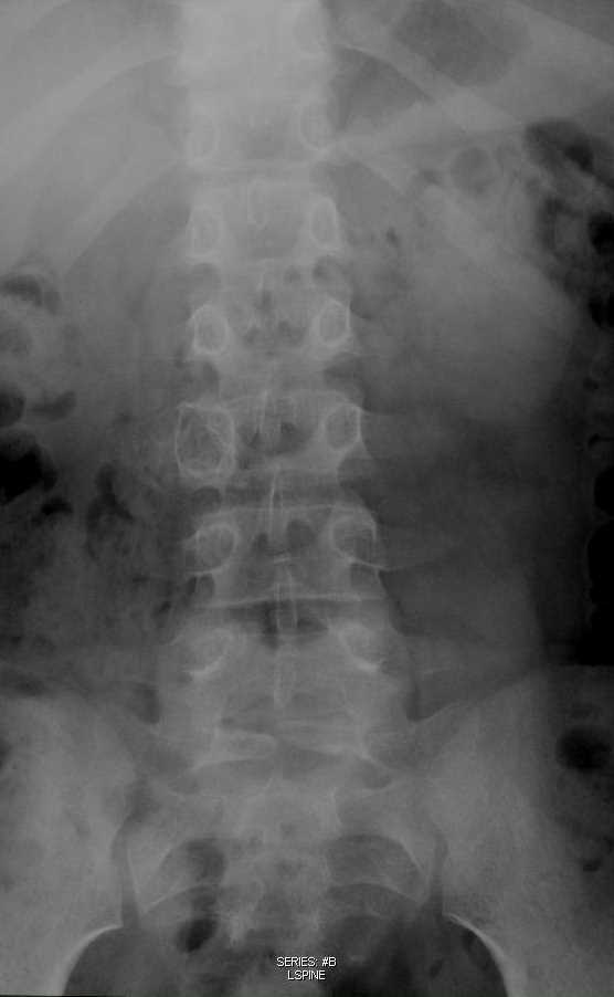 Aneurysmal Bone Cyst L3 Pedicle - CTisus CT Scan