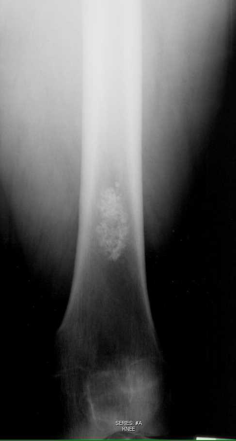 Enchondroma Distal Femur - CTisus CT Scan