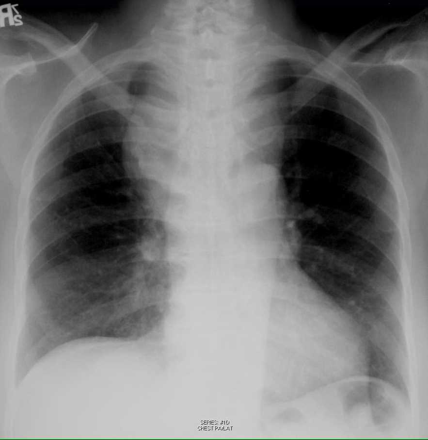 Thyroid Goiter on Chest X-ray - CTisus CT Scan