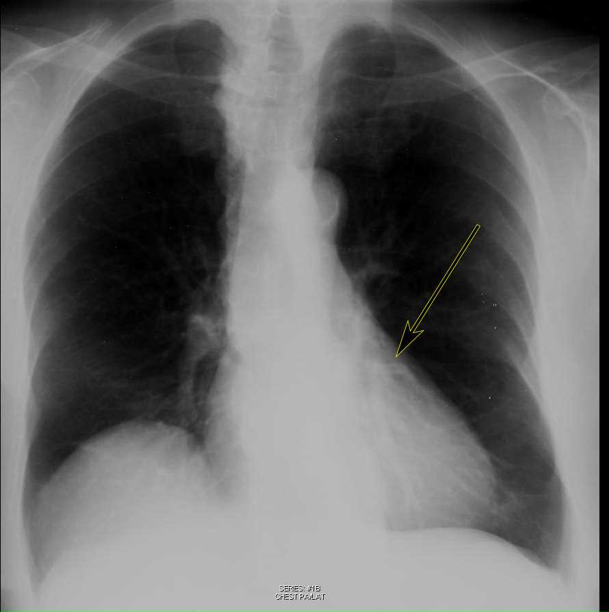 Coronary Calcification on Chest X-ray - X Rays Case Studies - CTisus CT ...