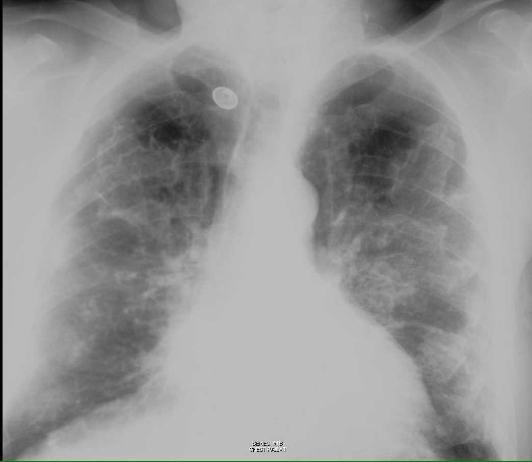 Calcified Pleural Plaques on Chest X-ray - CTisus CT Scan