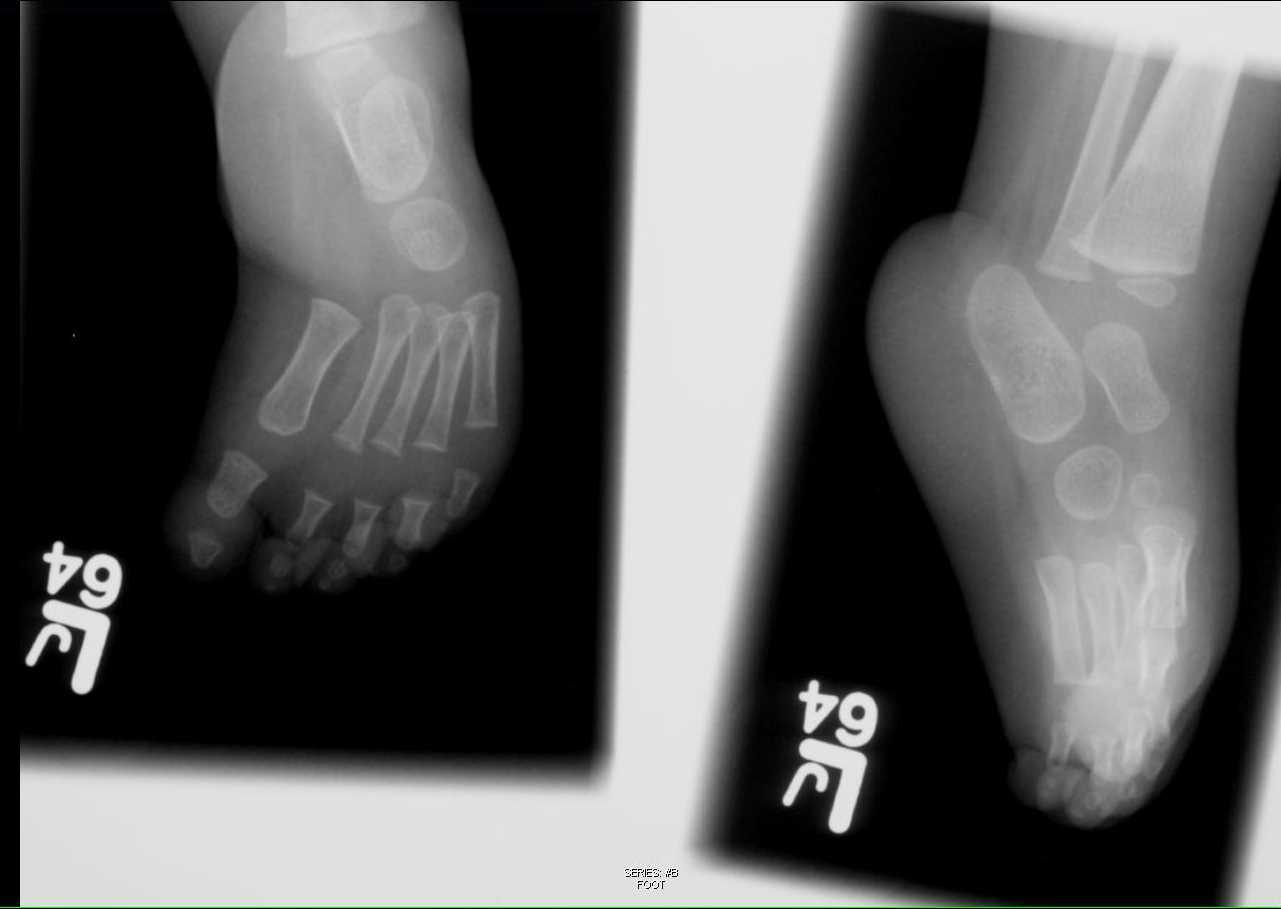 Club Feet on X-ray - CTisus CT Scan