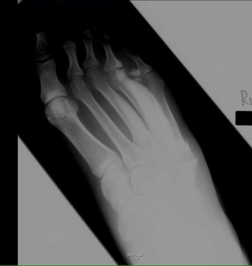 Melorheostosis Foot on X-ray - CTisus CT Scan