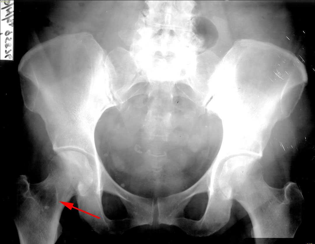 Intraosseous lipoma - CTisus CT Scan