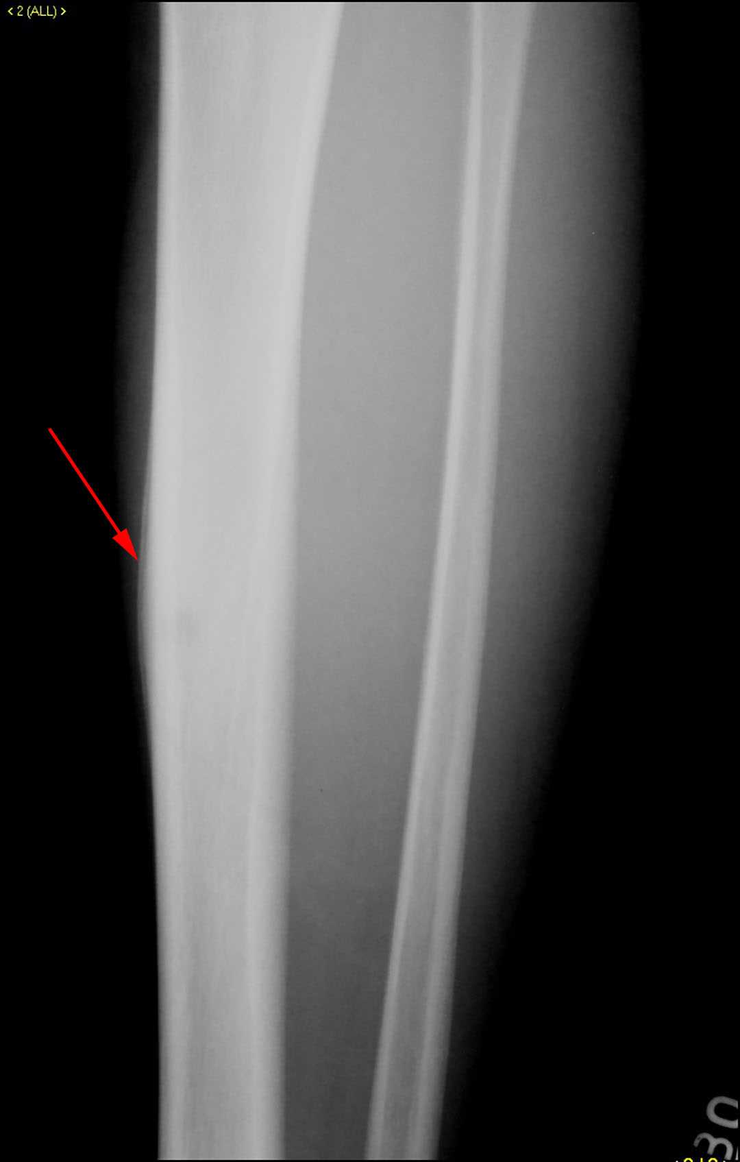 Osteoid Osteoma of the Tibia - CTisus CT Scan