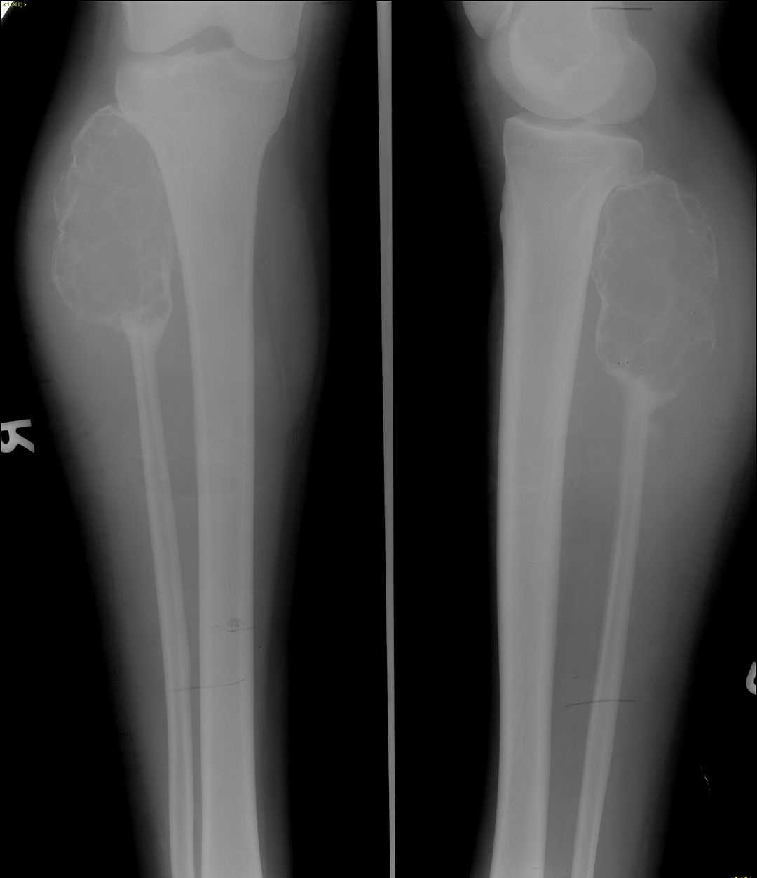 Giant Cell Tumor - X Rays Case Studies - CTisus CT Scanning