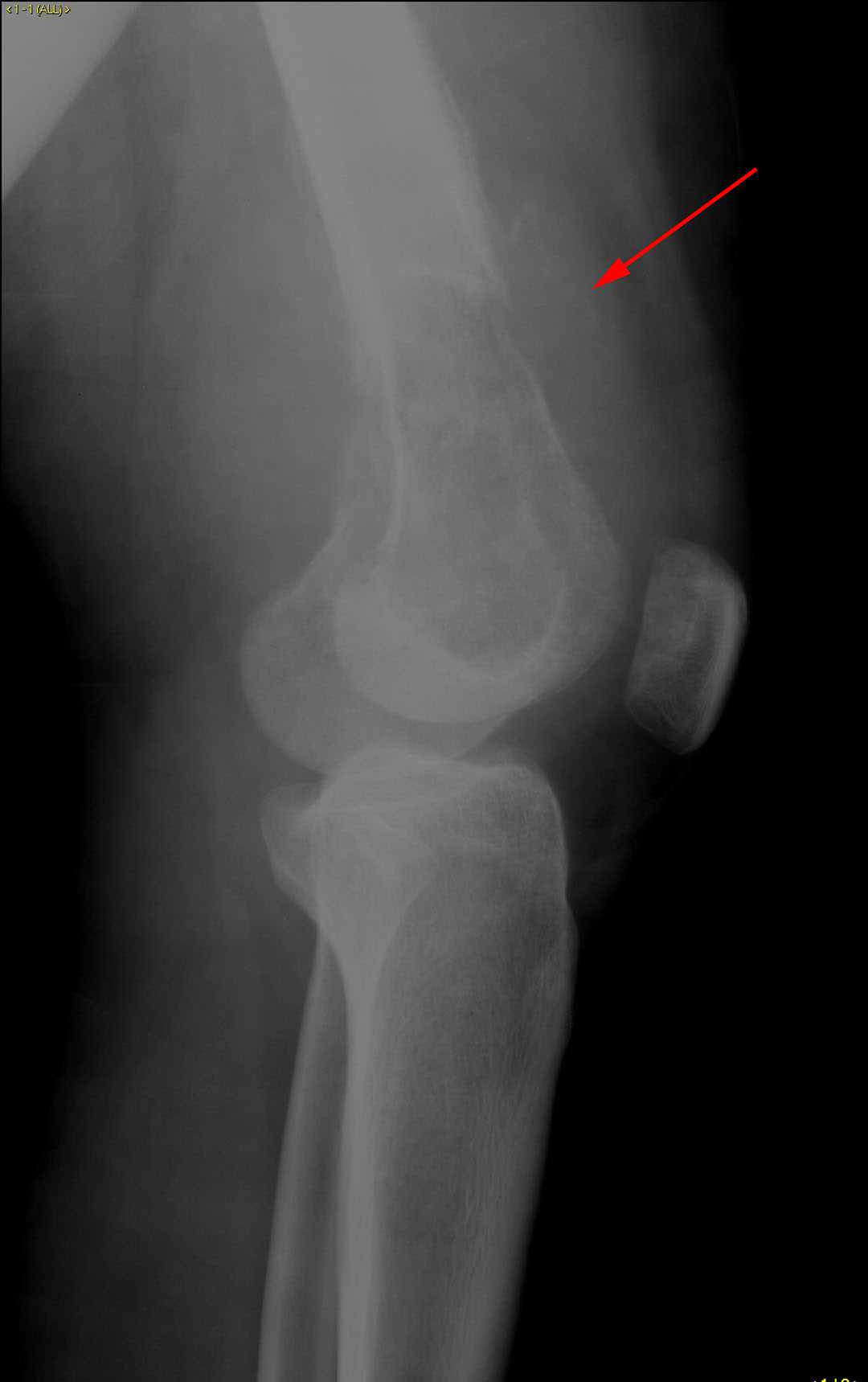 Osteosarcoma Case Study