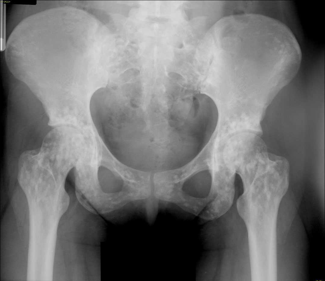 Osteopoikilosis - CTisus CT Scan