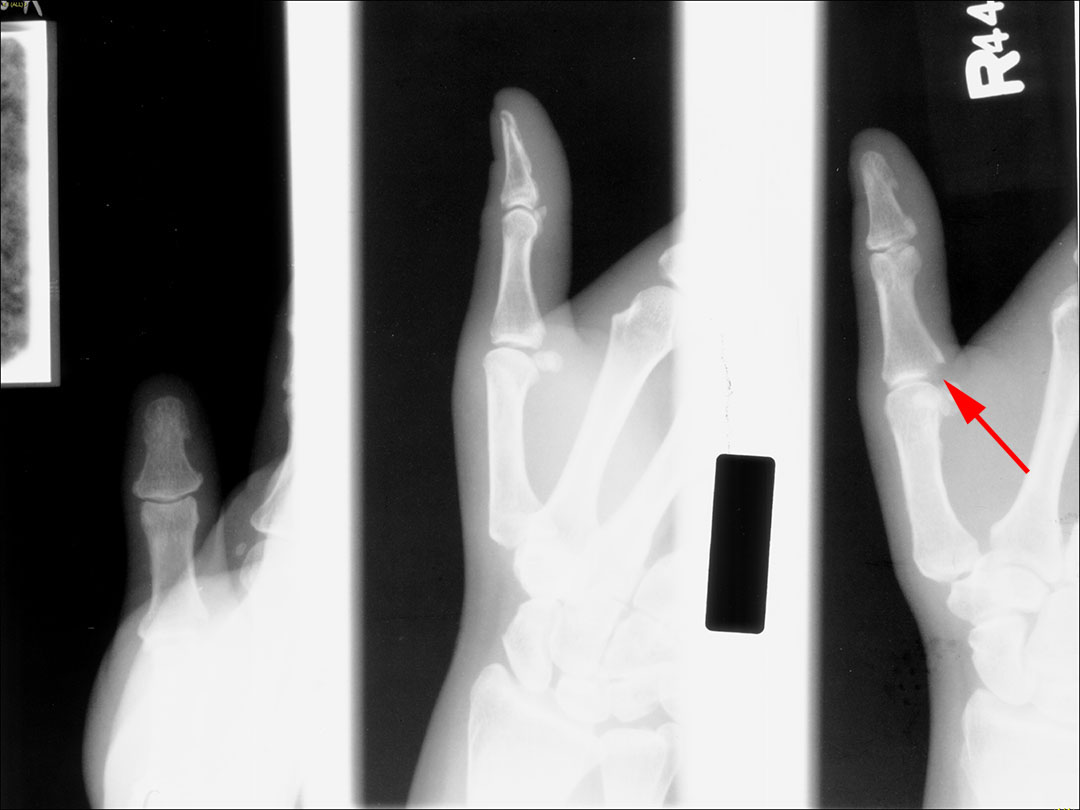 Gamekeepers thumb - CTisus CT Scan