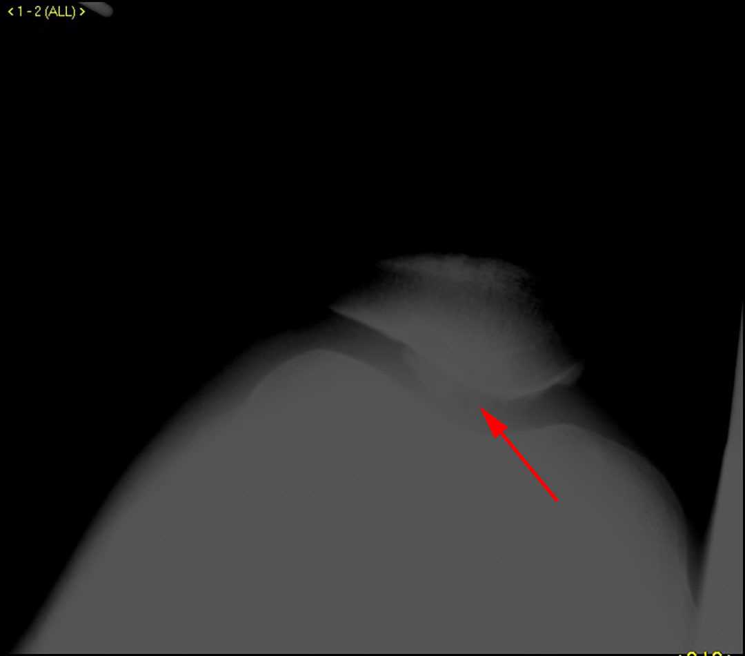 Osteochondritis dissecans (OCD) patella - CTisus CT Scan