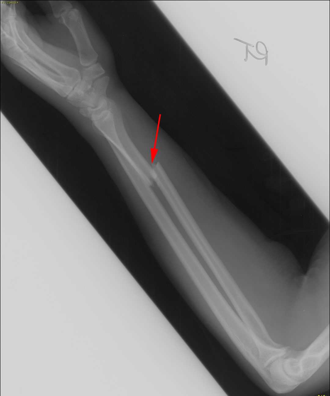 galeazzi fracture healing time