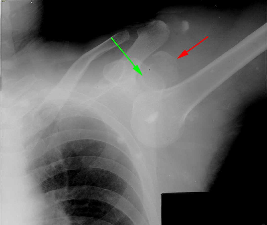 Luxatio Erecta - X Rays Case Studies - CTisus CT Scanning