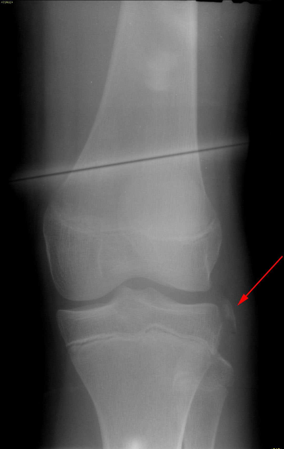 Segond Fracture - CTisus CT Scan