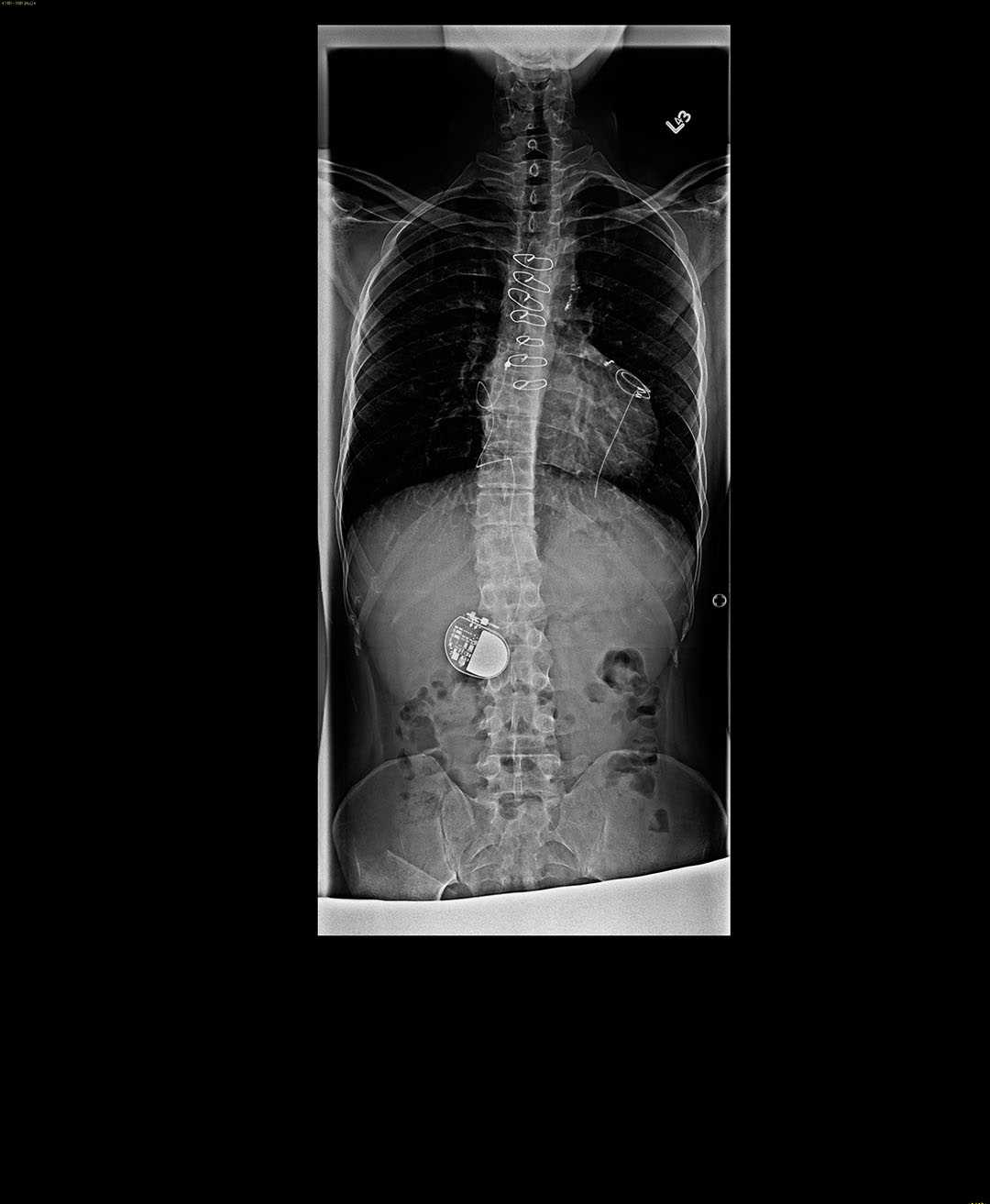 Scheuermann's Disease - X Rays Case Studies - CTisus CT Scanning