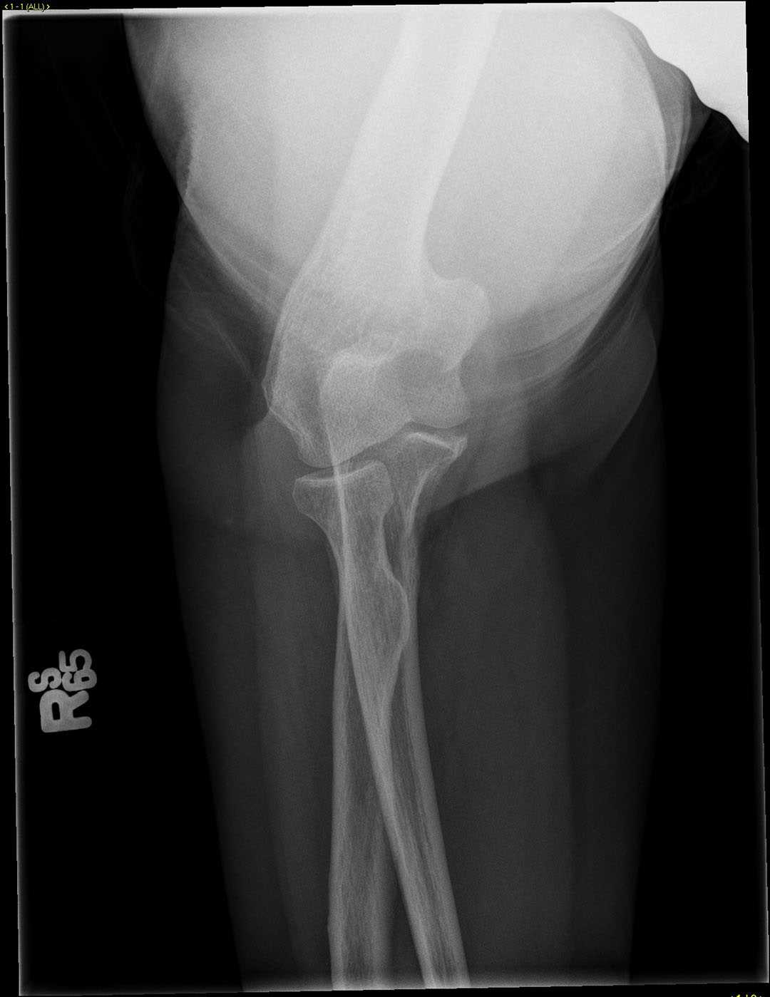 Radial HED fracture - CTisus CT Scan