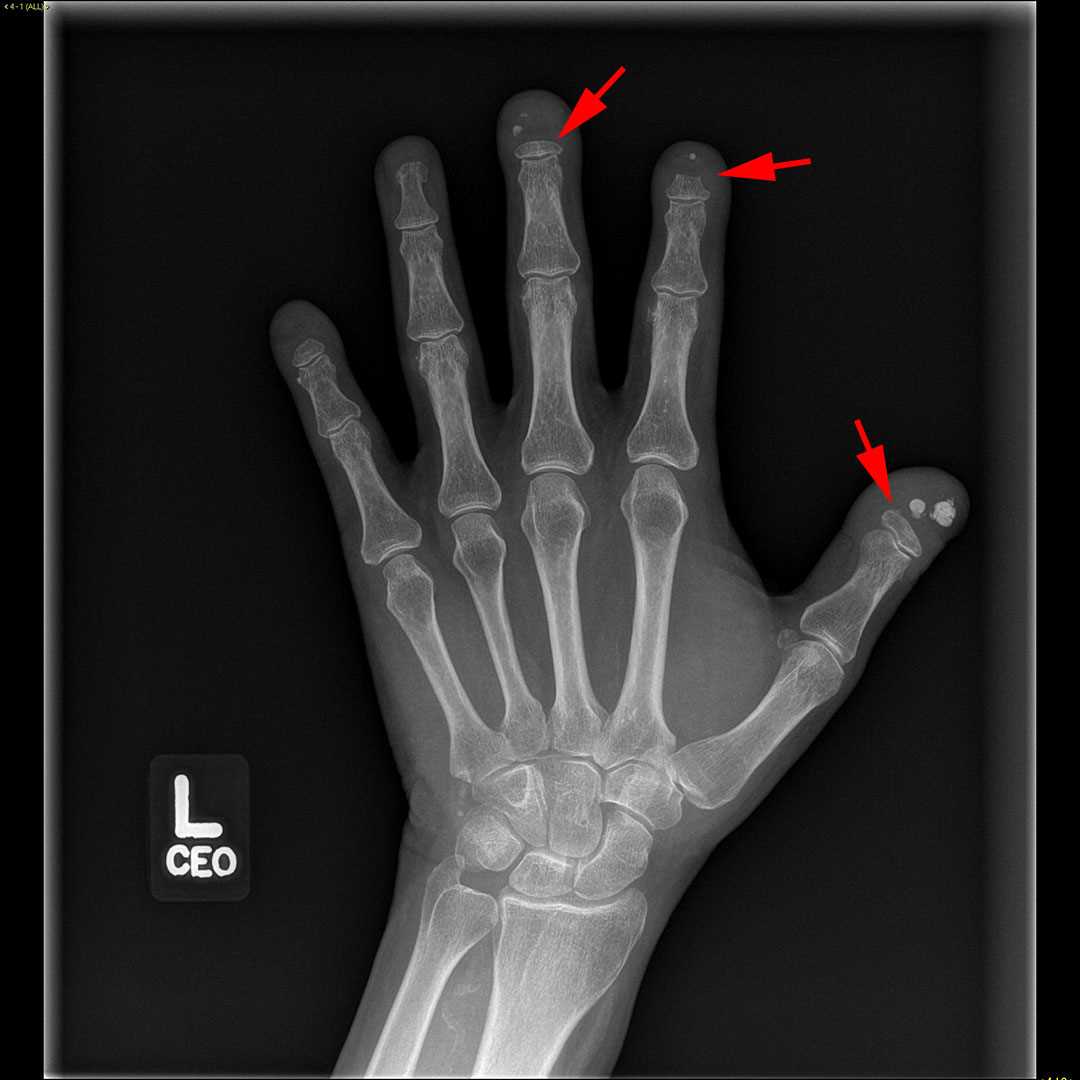 Scleroderma - CTisus CT Scan