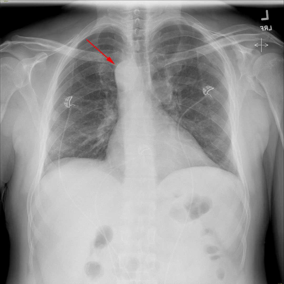 Right Aortic Arch - CTisus CT Scan