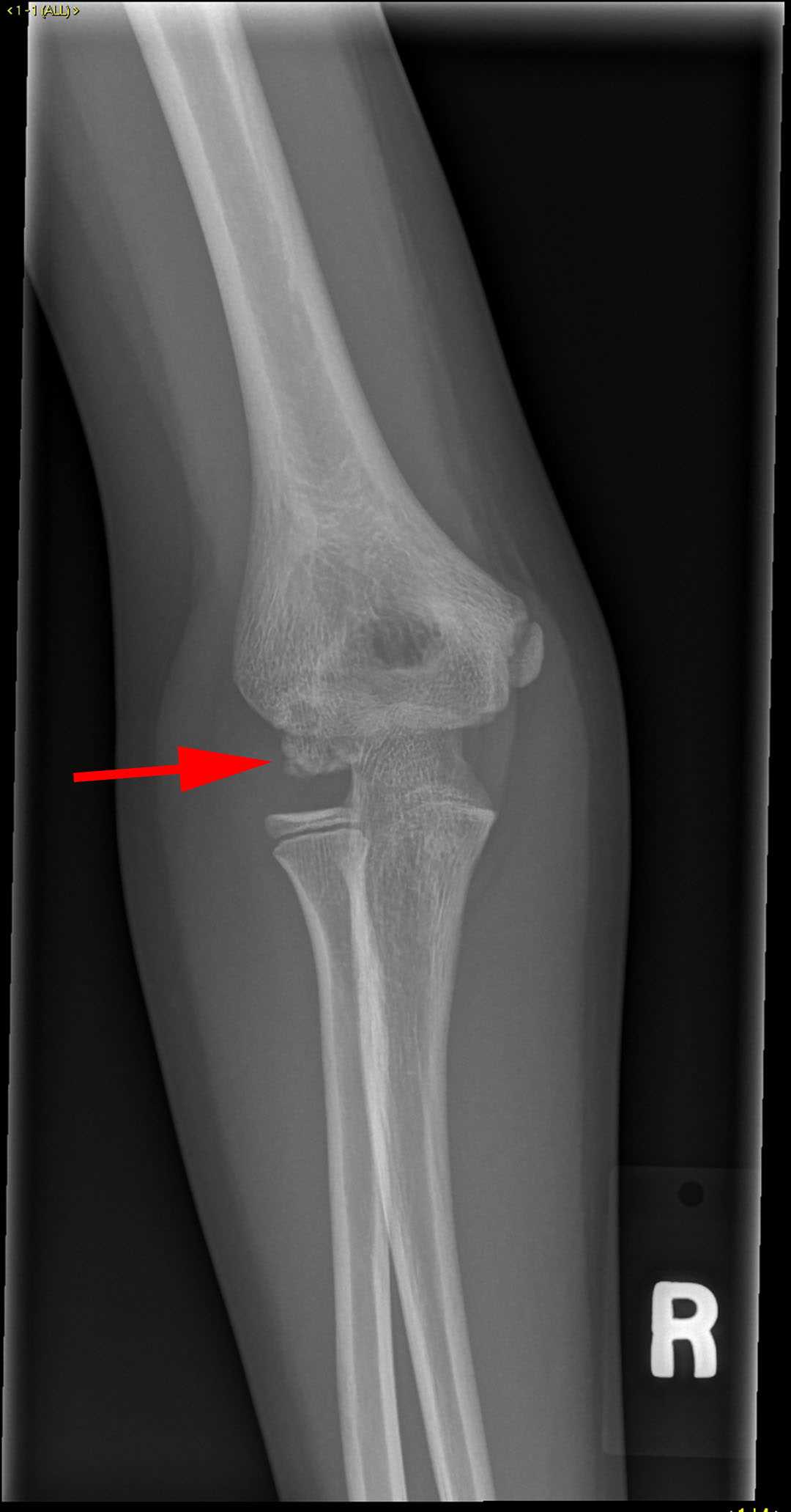 Panner Disease - CTisus CT Scan