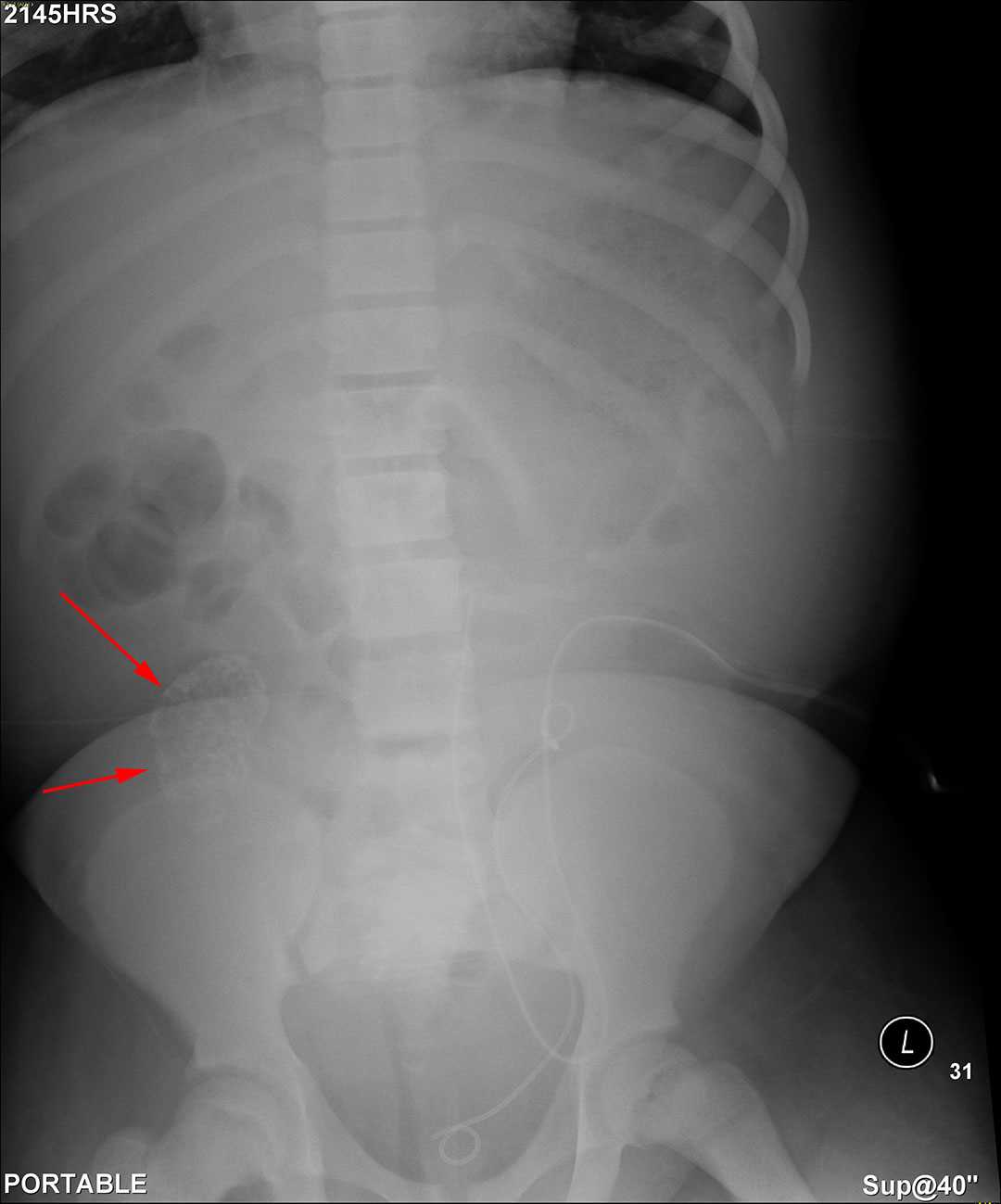 Chronic transplant rejection - CTisus CT Scan