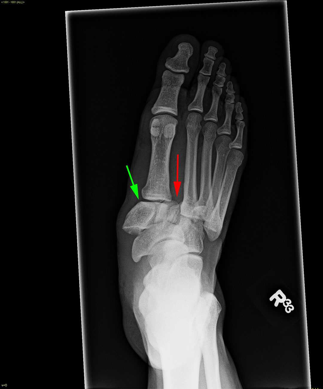 Lisfranc Fracture Dislocation - CTisus CT Scan