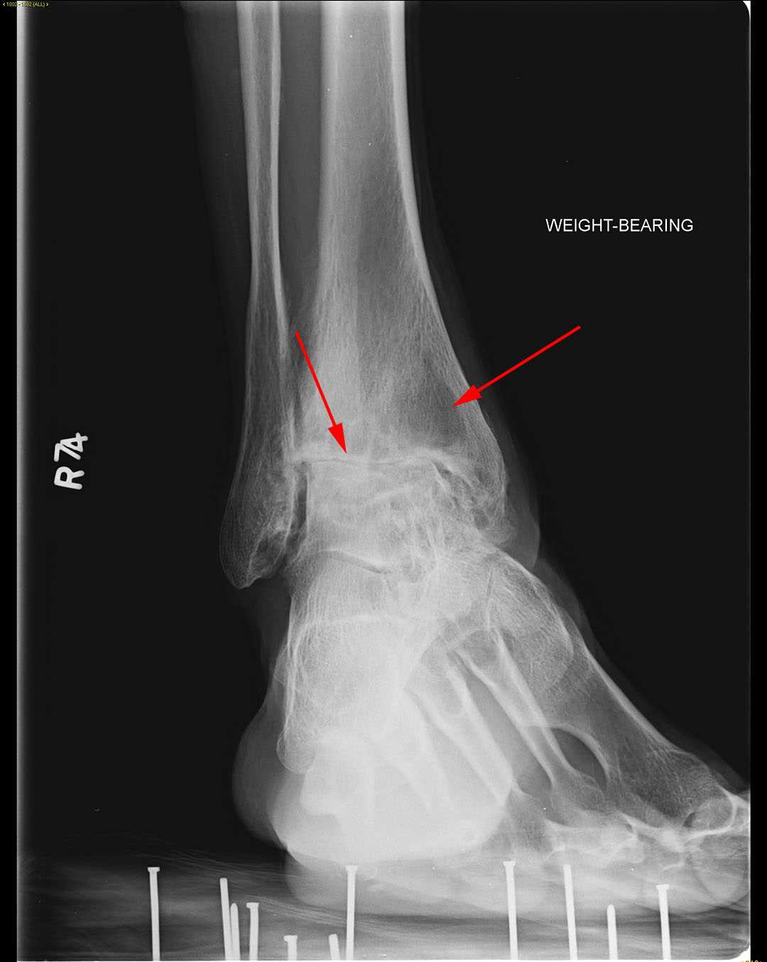 Hemophilic arthropathy - CTisus CT Scan