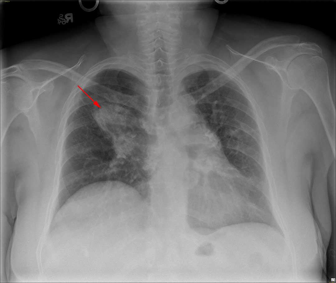 Aspergilloma - CTisus CT Scan