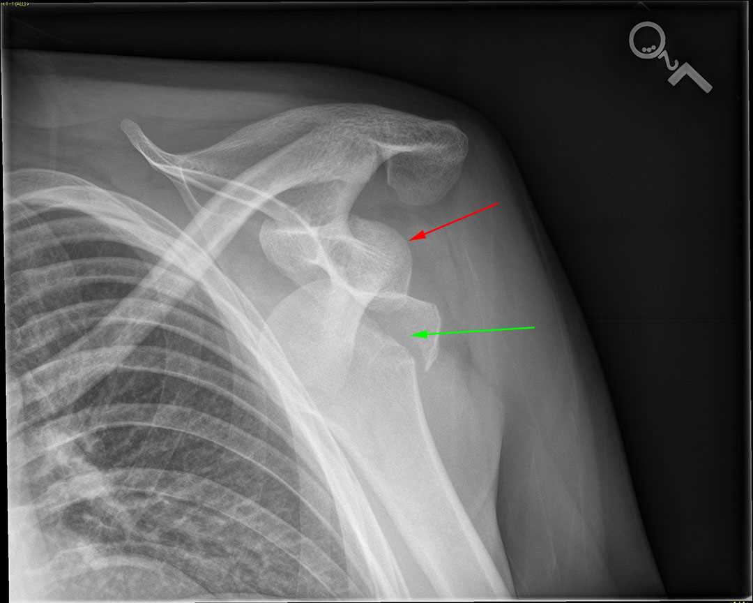 Bilateral shoulder dislocation - CTisus CT Scan