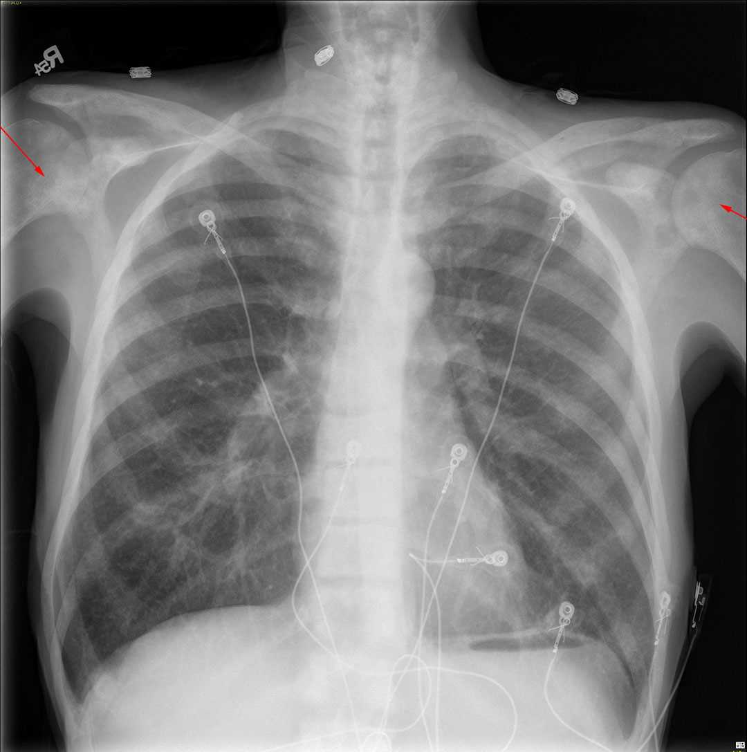 metastatic-prostate-cancer-x-rays-case-studies-ctisus-ct-scanning