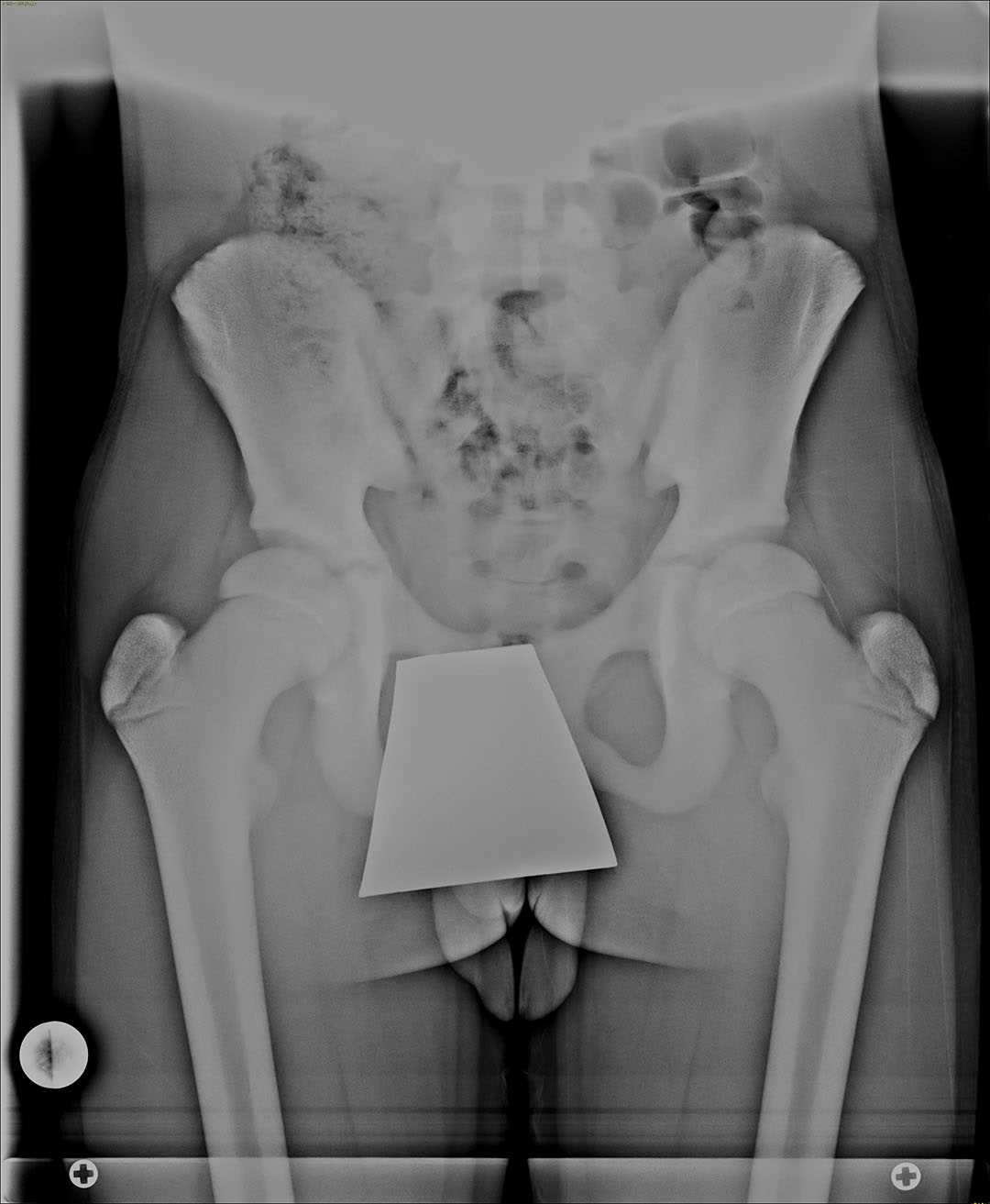 Osteopetrosis - CTisus CT Scan
